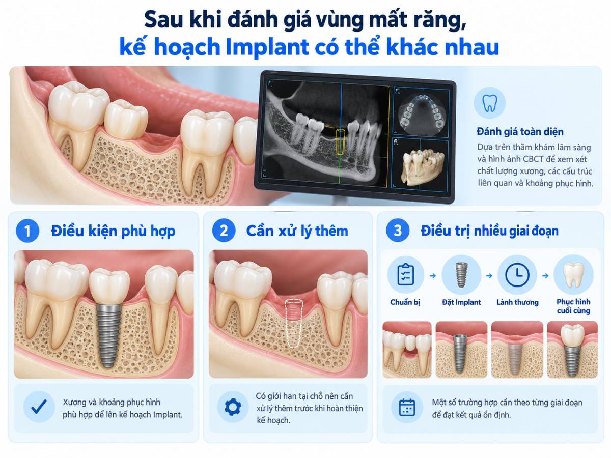 Ba kịch bản điều trị Implant sau khi đánh giá vùng mất răng lâu năm
